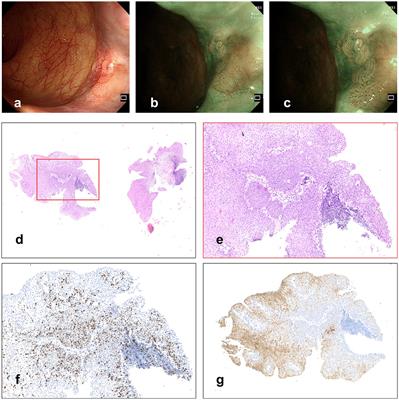 Case report: a precancerous lesion associated with HPV in the anal canal diagnosed by magnifying endoscopy with narrow-band imaging and resected by endoscopic submucosal dissection